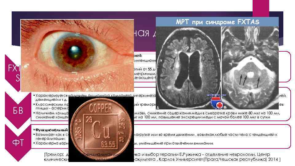 Дифференциальная диагностика FXTA S БВ ФТ • Синдром ломкой х-хромосомы с тремором и атаксией