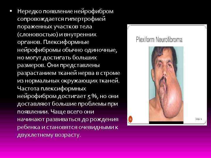 Нередко появление нейрофибром сопровождается гипертрофией пораженных участков тела (слоновостью) и внутренних органов. Плексиформные