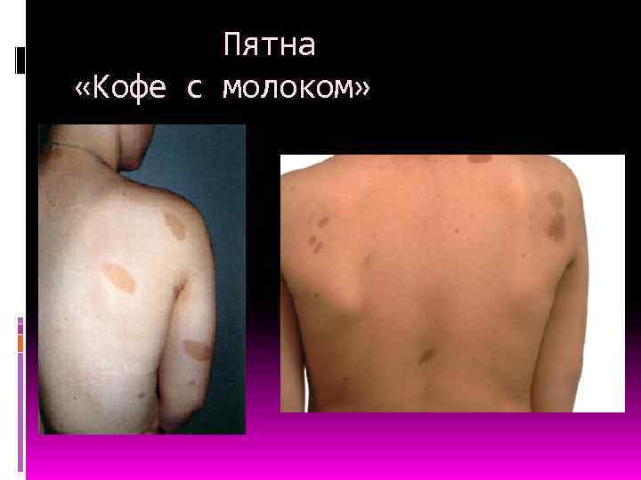  Пятна «Кофе с молоком» 