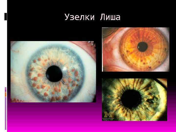 Узелки Лиша 