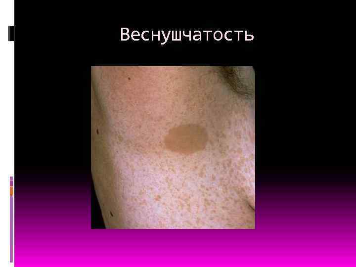 Веснушчатость 
