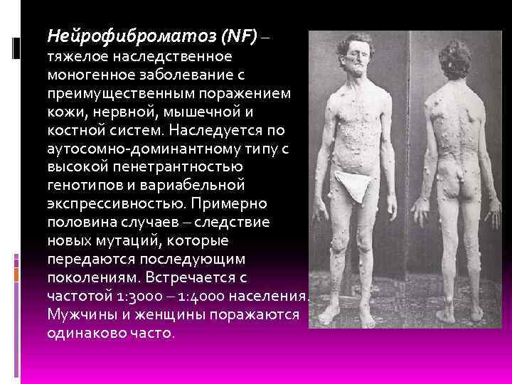 Нейрофиброматоз (NF) – тяжелое наследственное моногенное заболевание с преимущественным поражением кожи, нервной, мышечной и