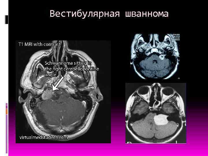 Вестибулярная шваннома 