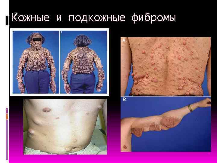  Кожные и подкожные фибромы 