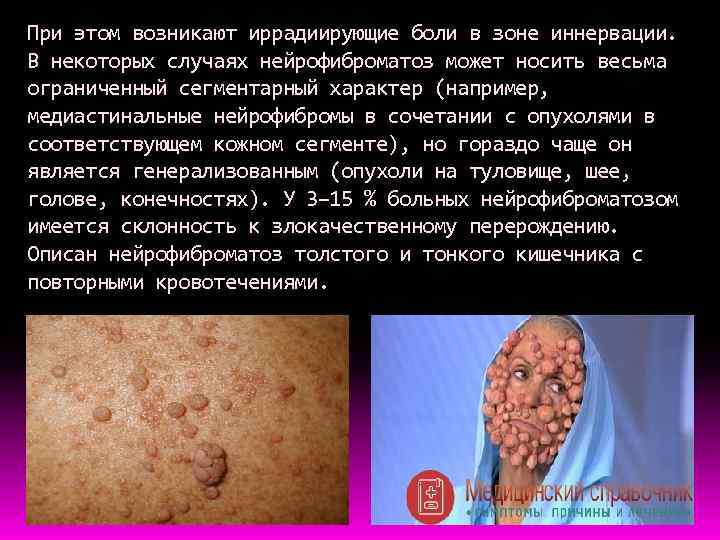 При этом возникают иррадиирующие боли в зоне иннервации. В некоторых случаях нейрофиброматоз может носить