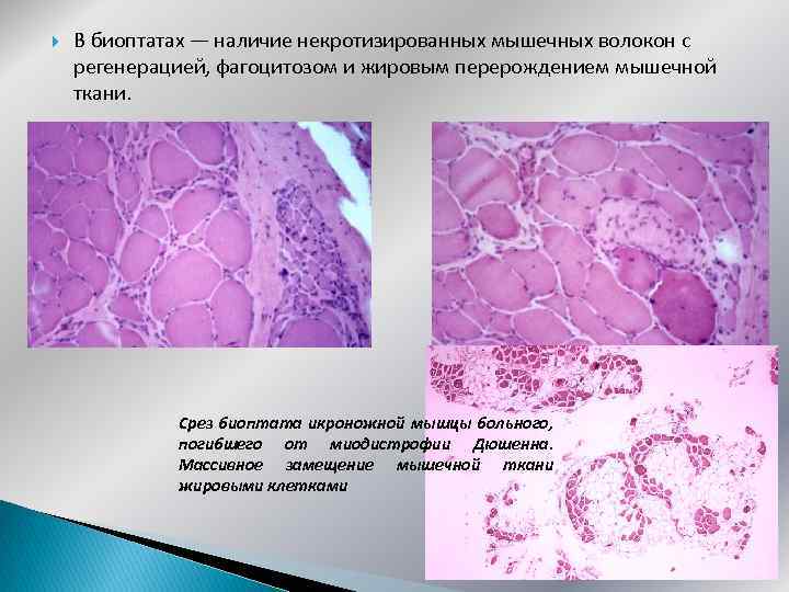  В биоптатах — наличие некротизированных мышечных волокон с регенерацией, фагоцитозом и жировым перерождением
