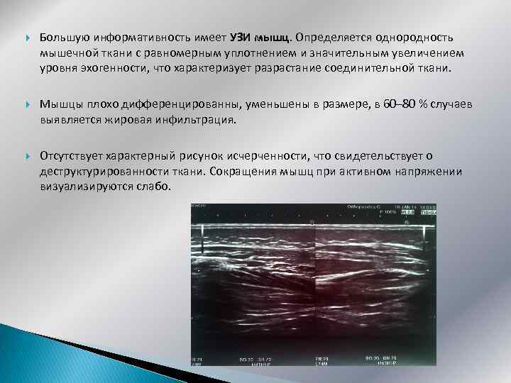  Большую информативность имеет УЗИ мышц. Определяется однородность мышечной ткани с равномерным уплотнением и