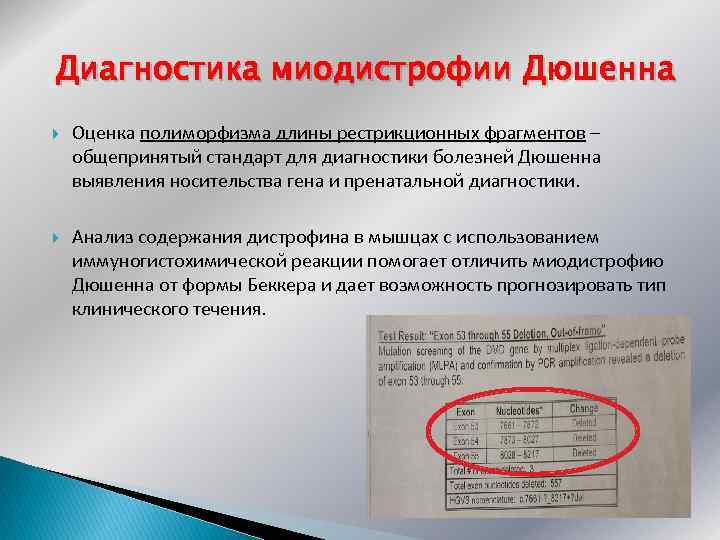 Диагностика миодистрофии Дюшенна Оценка полиморфизма длины рестрикционных фрагментов – общепринятый стандарт для диагностики болезней