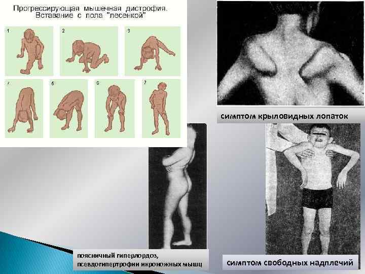 симптом крыловидных лопаток поясничный гиперлордоз, псевдогипертрофии икроножных мышц симптом свободных надплечий 