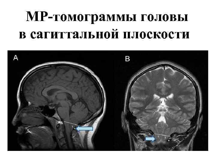 МР-томограммы головы в сагиттальной плоскости 