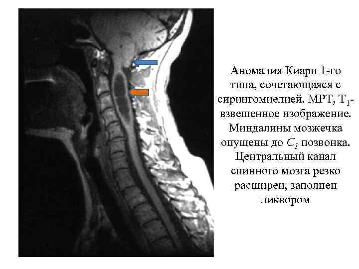 Аномалия Киари 1 -го типа, сочетающаяся с сирингомиелией. МРТ, Т 1 взвешенное изображение. Миндалины