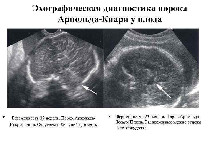 Эхографическая диагностика порока Арнольда-Киари у плода • Беременность 37 недель. Порок Арнольда. Киари I