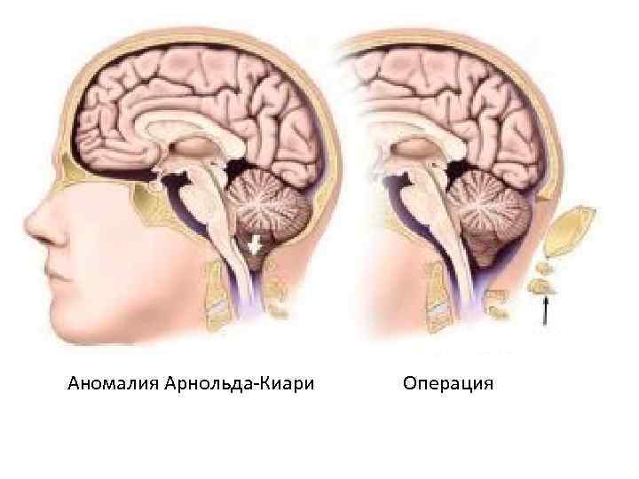  Аномалия Арнольда-Киари Операция 