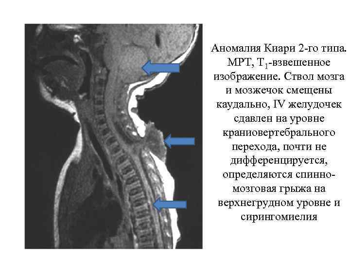 Аномалия Киари 2 -го типа. МРТ, Т 1 -взвешенное изображение. Ствол мозга и мозжечок