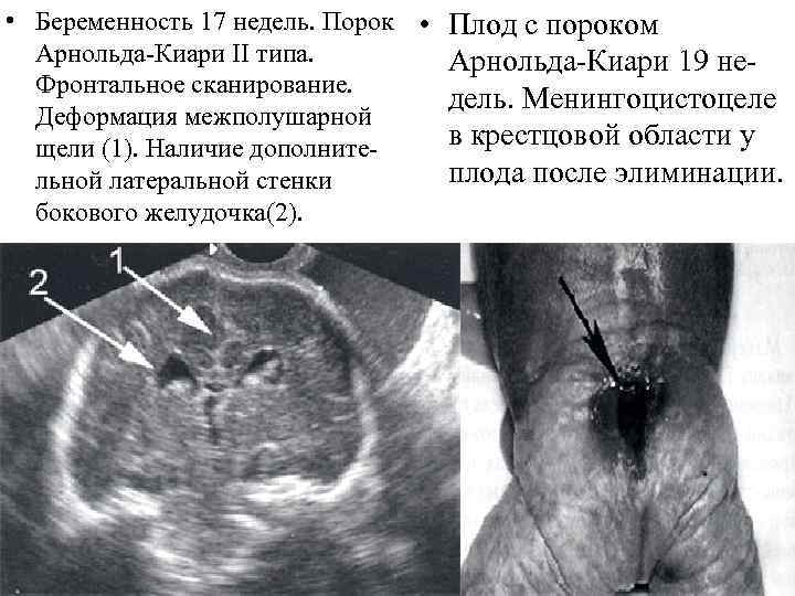  • Беременность 17 недель. Порок • Арнольда-Киари II типа. Фронтальное сканирование. Деформация межполушарной