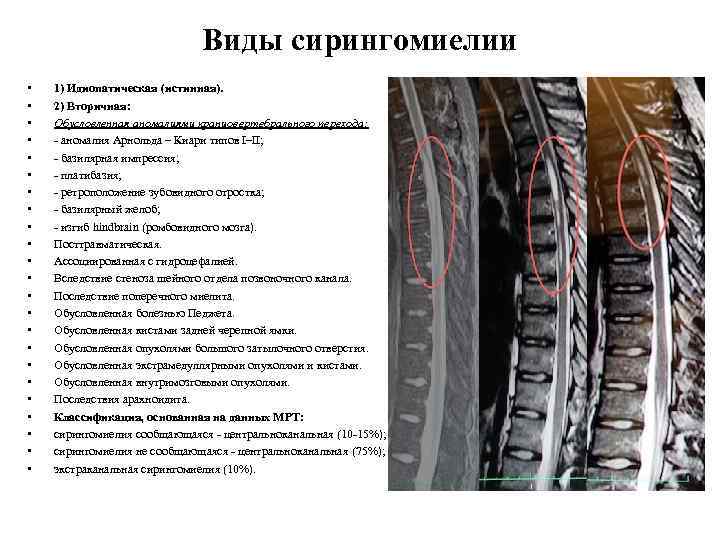 Виды сирингомиелии • • • • • • 1) Идиопатическая (истинная). 2) Вторичная: Обусловленная