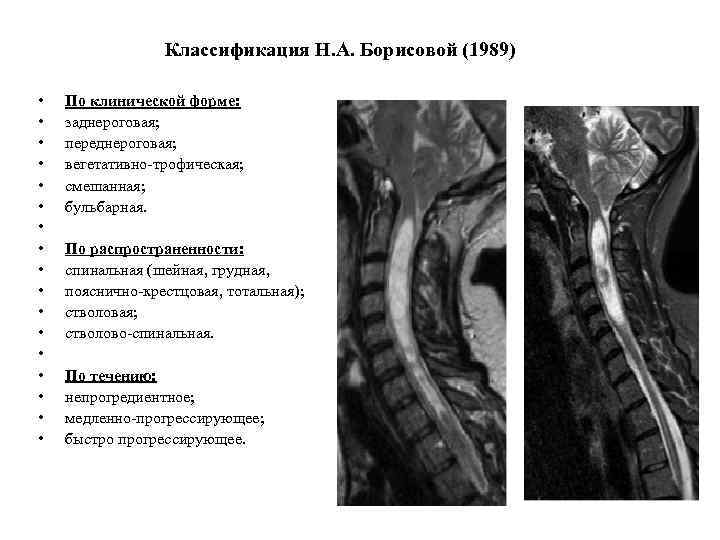 Классификация Н. А. Борисовой (1989) • • • • • По клинической форме: заднероговая;