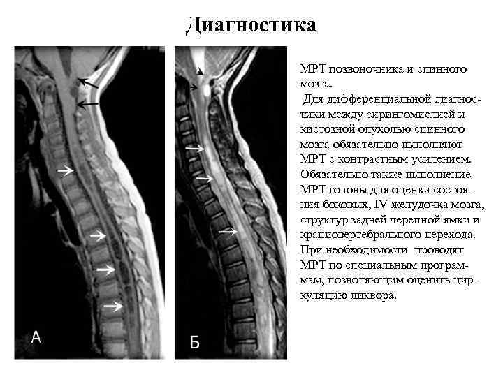 Диагностика МРТ позвоночника и спинного мозга. Для дифференциальной диагностики между сирингомиелией и кистозной опухолью