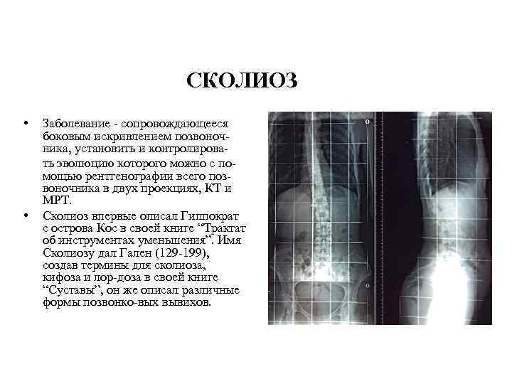 СКОЛИОЗ • Заболевание - сопровождающееся боковым искривлением позвоночника, установить и контролирова ть эволюцию которого