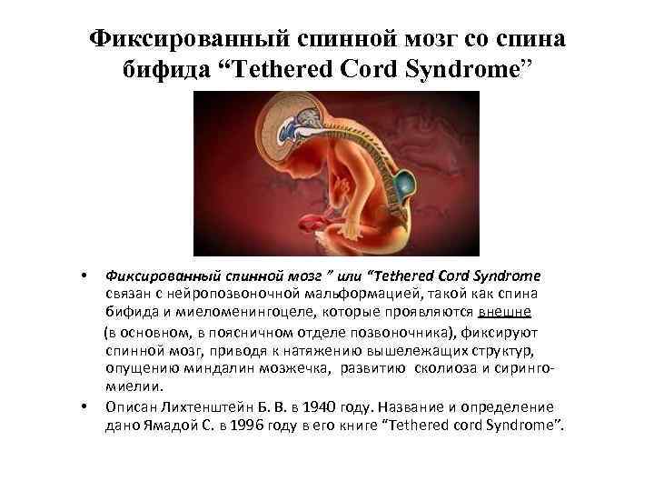 Фиксированный спинной мозг со спина бифида “Tethered Cord Syndrome” Фиксированный спинной мозг ” или