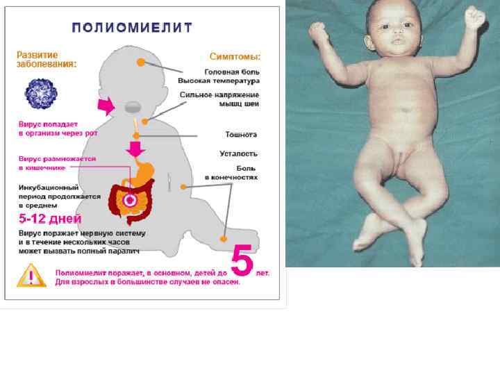 Полиомиелит симптомы. Абортивная форма полиомиелита. Полиомиелит проявления. Полиомиелит периоды заболевания.