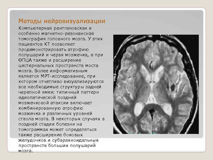 Методы нейровизуализации Компьютерная рентгеновская и особенно магнитно-резонансная томография головного мозга. У этих пациентов КТ
