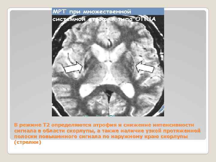 В режиме Т 2 определяются атрофия и снижение интенсивности сигнала в области скорлупы, а