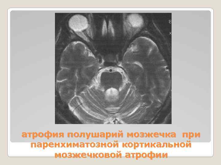 атрофия полушарий мозжечка при паренхиматозной кортикальной мозжечковой атрофии 