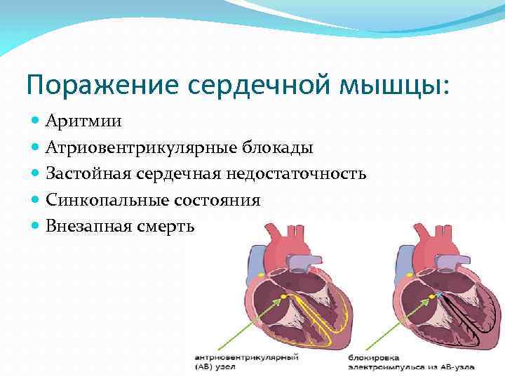 Поражение сердечной мышцы: Аритмии Атриовентрикулярные блокады Застойная сердечная недостаточность Синкопальные состояния Внезапная смерть 