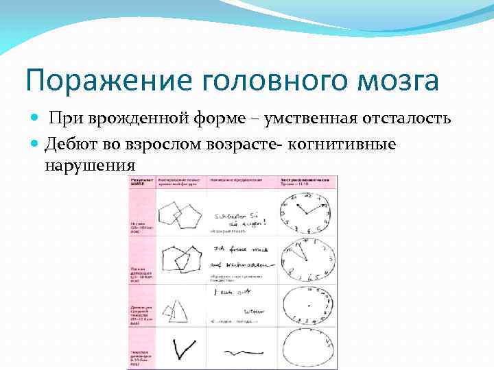 Поражение головного мозга При врожденной форме – умственная отсталость Дебют во взрослом возрасте- когнитивные