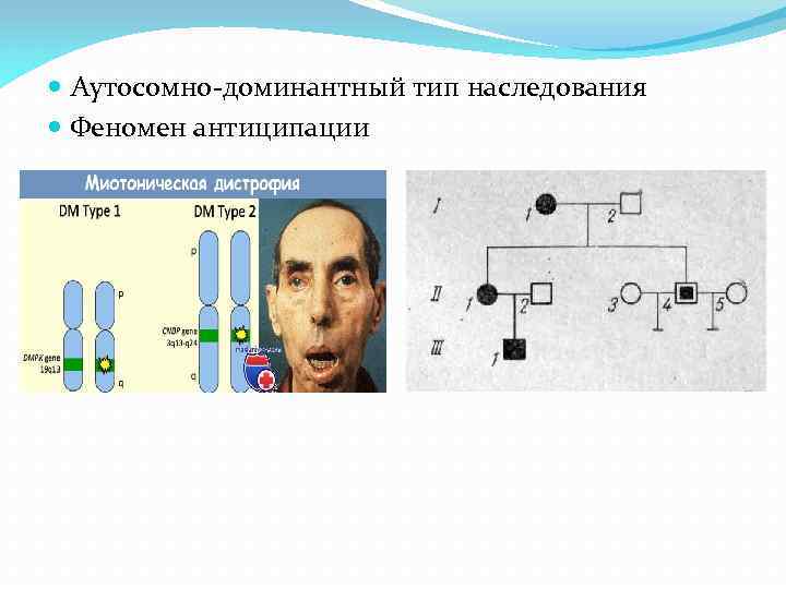  Аутосомно-доминантный тип наследования Феномен антиципации 