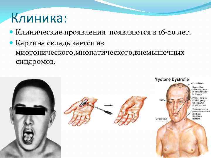 Клиника: Клинические проявления появляются в 16 -20 лет. Картина складывается из миотонического, миопатического, внемышечных