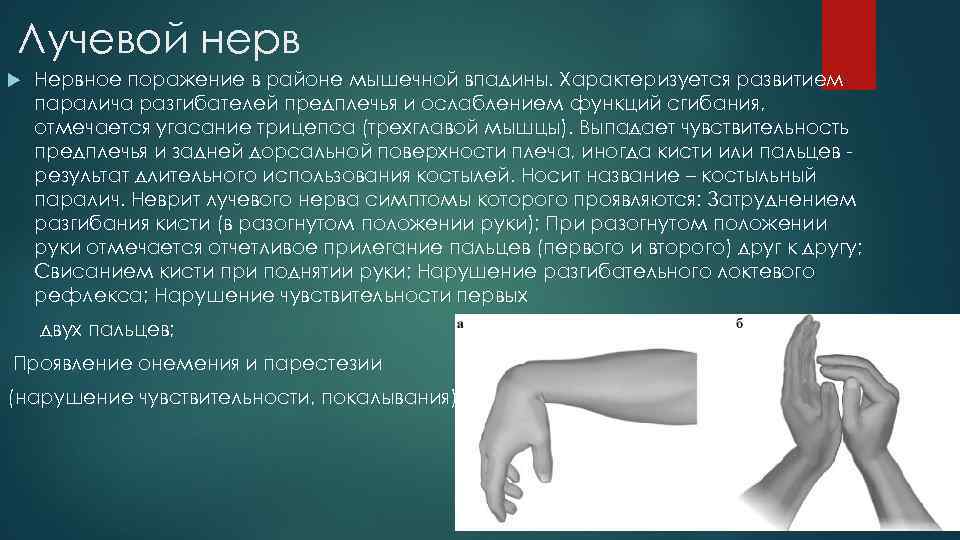 Лучевой нерв Нервное поражение в районе мышечной впадины. Характеризуется развитием паралича разгибателей предплечья и