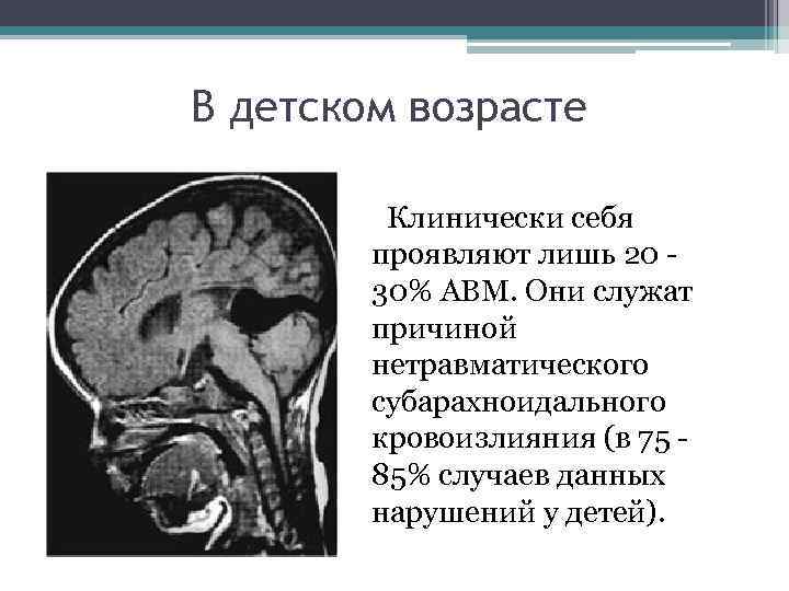В детском возрасте Клинически себя проявляют лишь 20 - 30% АВМ. Они служат причиной