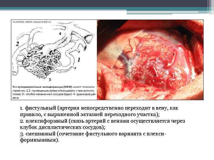1. фистульный (артерия непосредственно переходит в вену, как правило, с выраженной эктазией переходного участка);