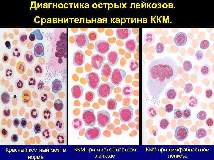 Диагностика острых лейкозов. Сравнительная картина ККМ. Красный костный мозг в норме ККМ при миелобластном