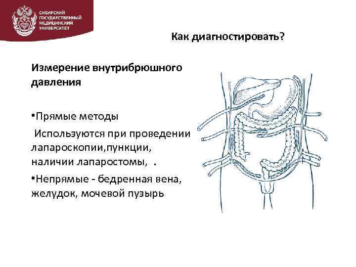 Как диагностировать? Измерение внутрибрюшного давления • Прямые методы Используются при проведении лапароскопии, пункции, наличии