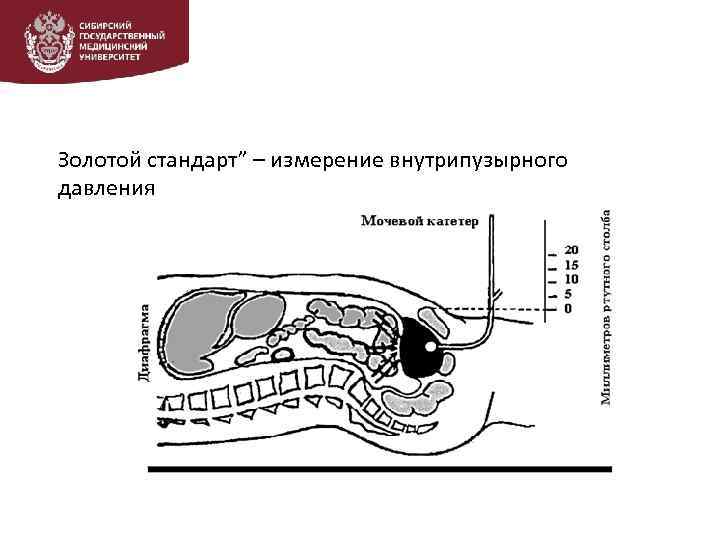 Золотой стандарт” – измерение внутрипузырного давления 