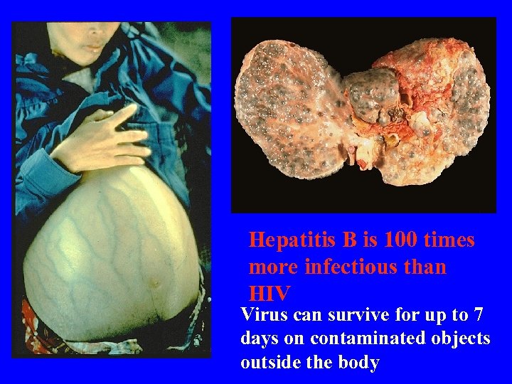 Hepatitis B is 100 times more infectious than HIV Virus can survive for up