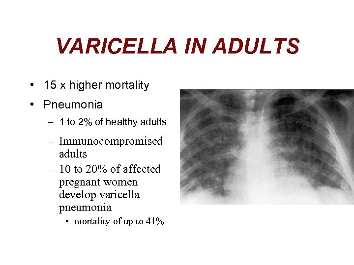 VARICELLA IN ADULTS • 15 x higher mortality • Pneumonia – 1 to 2%