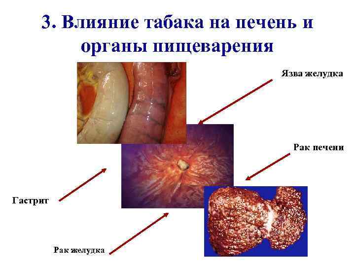 3. Влияние табака на печень и органы пищеварения Язва желудка Рак печени Гастрит Рак