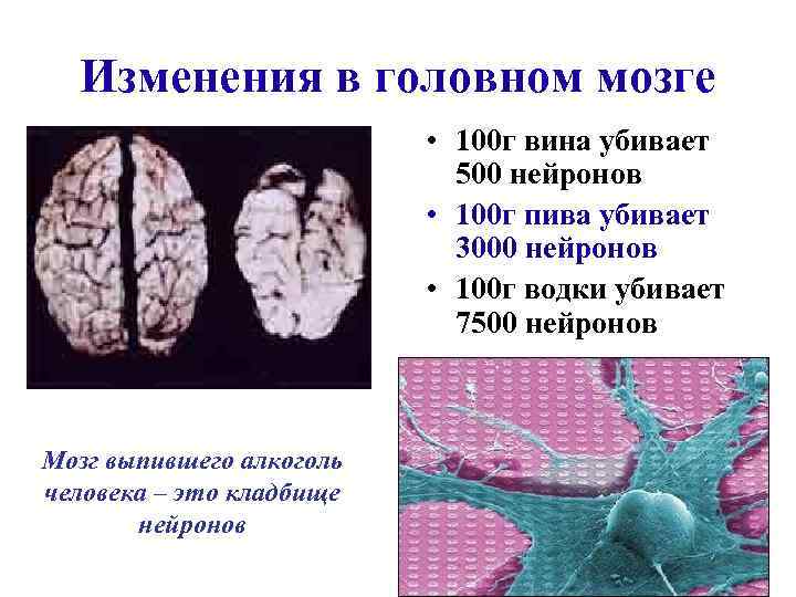 Изменения в головном мозге • 100 г вина убивает 500 нейронов • 100 г