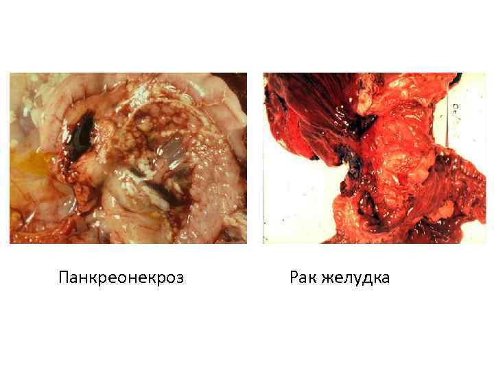 Панкреонекроз Рак желудка 