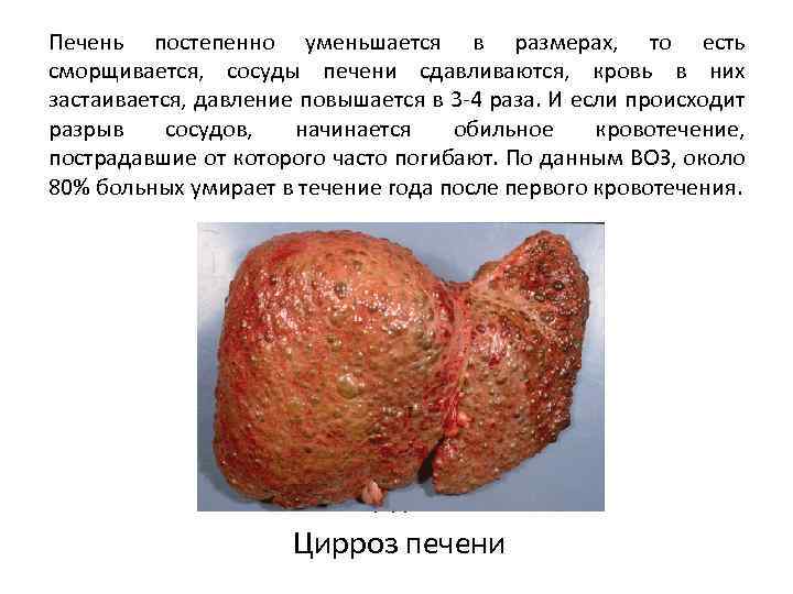 Печень постепенно уменьшается в размерах, то есть сморщивается, сосуды печени сдавливаются, кровь в них