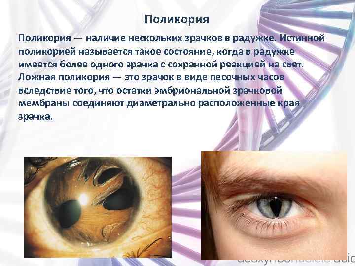 Поликория — наличие нескольких зрачков в радужке. Истинной поликорией называется такое состояние, когда в