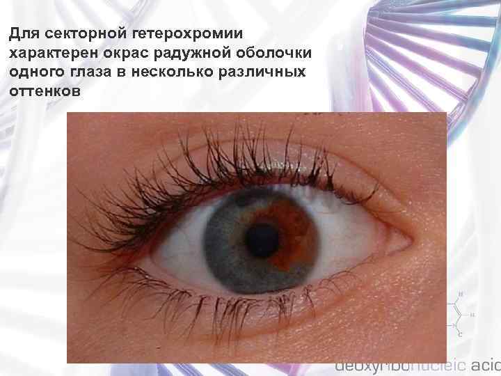 Для секторной гетерохромии характерен окрас радужной оболочки одного глаза в несколько различных оттенков 