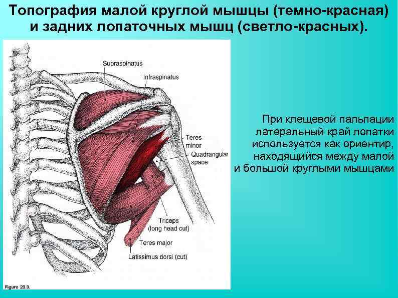 Топография малой круглой мышцы (темно-красная) и задних лопаточных мышц (светло-красных). При клещевой пальпации латеральный