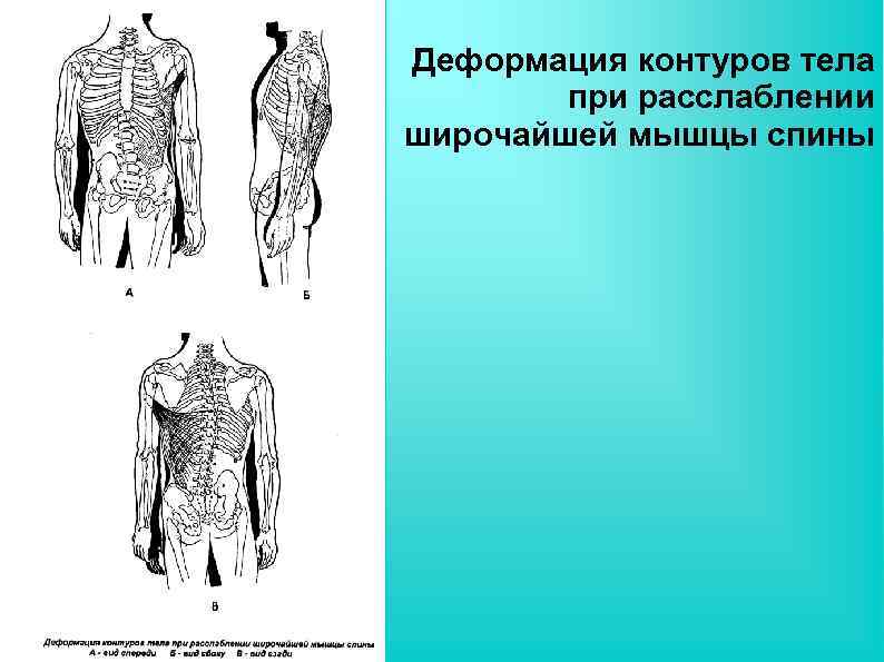 Деформация контуров тела при расслаблении широчайшей мышцы спины 