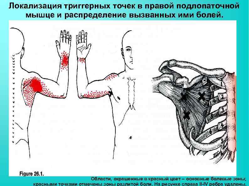 Локализация триггерных точек в правой подлопаточной мышце и распределение вызванных ими болей. Области, окрашенные