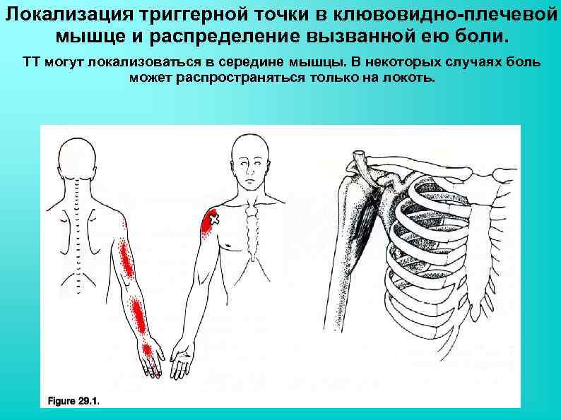 Тейпирование плечевого сустава при болях при поднятии руки схема рисунок